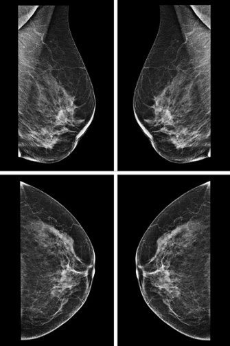 Mammogram_Dr.Hsu