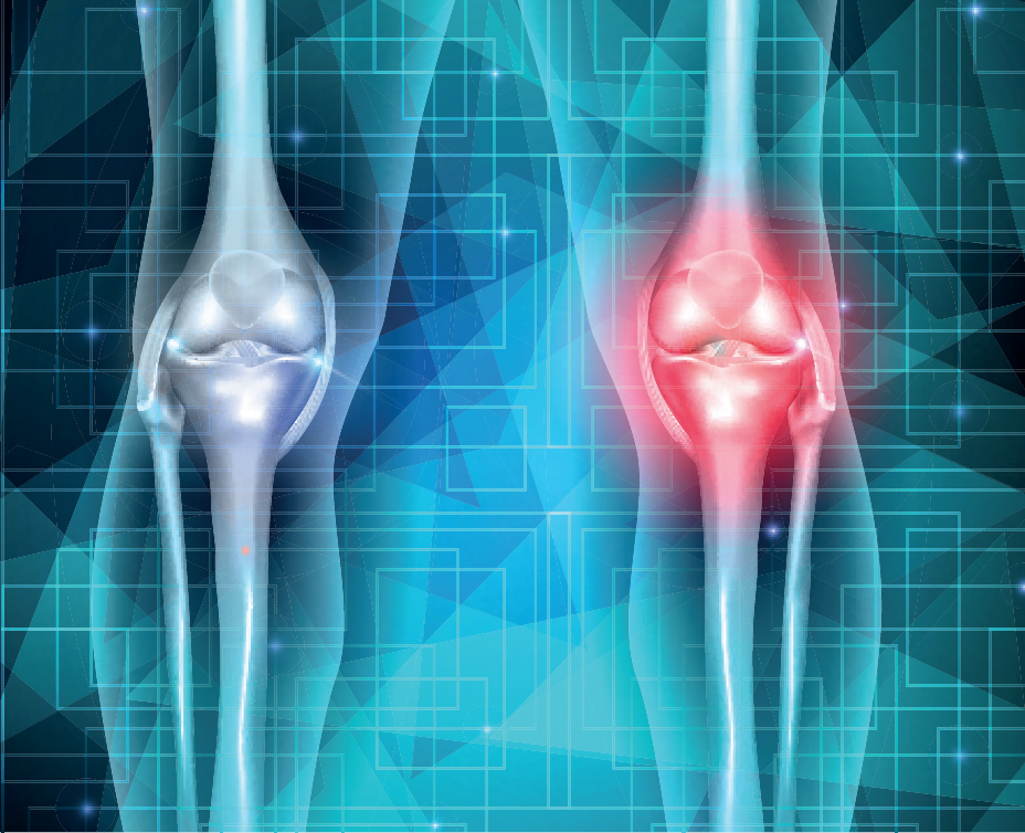What You Should Know About Osteoarthritis