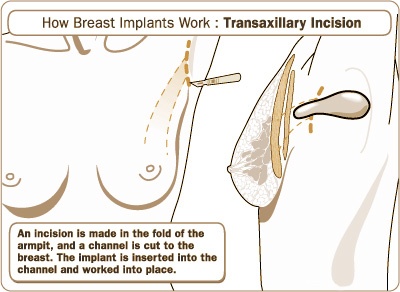 Transaxillary Breast Augmentation Incision