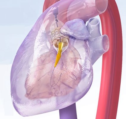 Christus Spohn’s TAVR Program Gives New Life to Cardiac Patients - MD ...