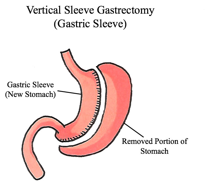Vertical-Sleeve-Gastrectomy