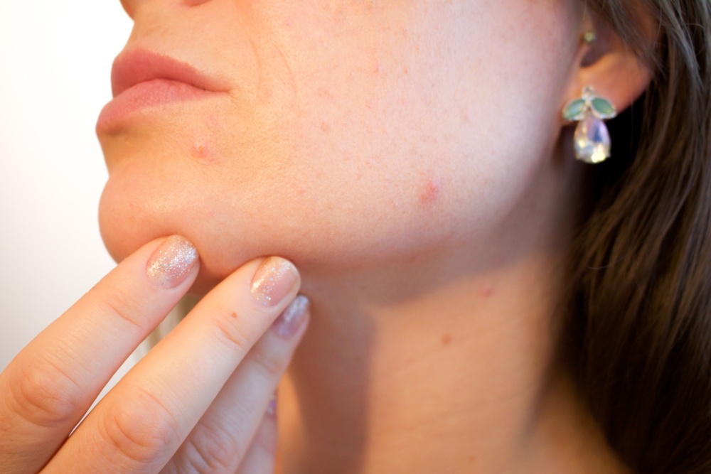 6 Hacks to Follow for Acne Prone Skin