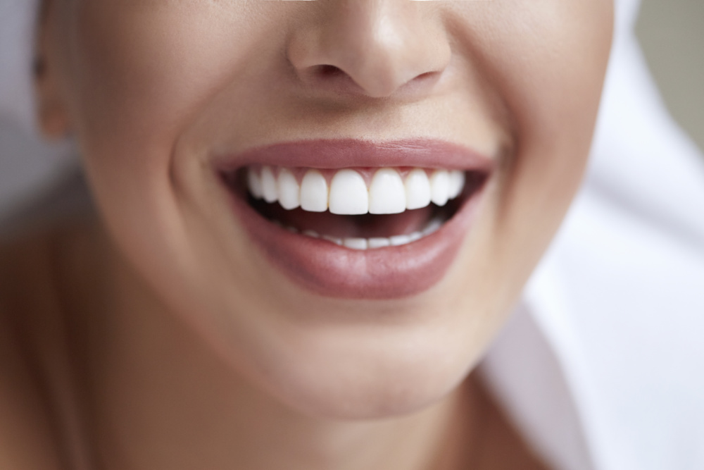 4 Reasons Why You Should Use Invisible Aligners for Teeth Straightening